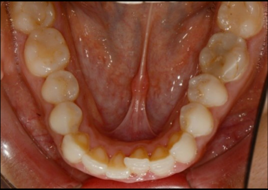 Foto de Oclusal