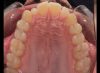 Foto de Oclusal