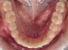 Foto de Oclusal