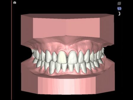 3D planning with NemoCast