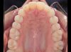 Occlusal Photo