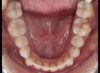 Occlusal Photo