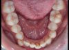 Occlusal Photo