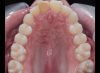 Occlusal Photo