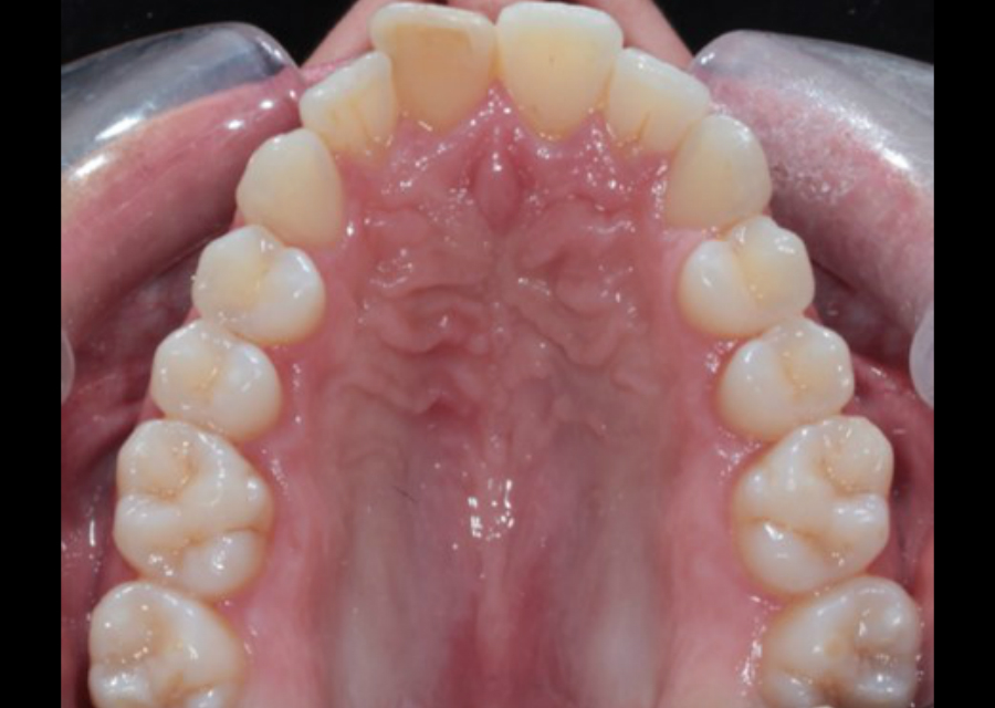 Occlusal Photo