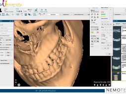 CORE VIDEO NemoSmile Design. Edit Mesh Tools by Dr. Javier Vasquez