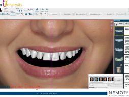 9. NemoSmile Design. Prosthetic Planning