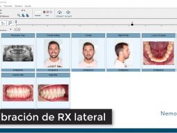 Calibración de RX lateral