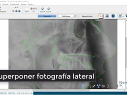 Superponer fotografía lateral
