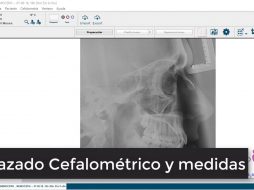 Trazado cefalométrico y medidas