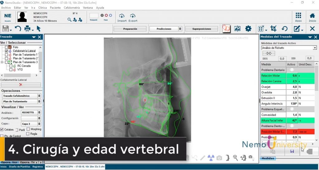 Cirugía y edad vertebral