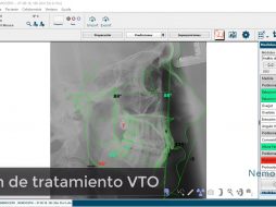 Plan de tratamiento VTO