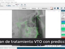 Plan de tratamiento VTO con predicción