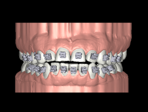 frontal bx negro