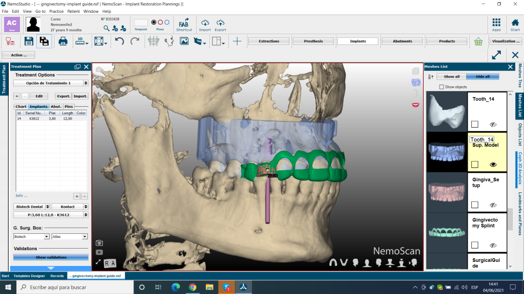 splint combinada de guia de gingivectomia y guia quirurgica de implantes (3)