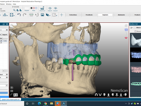 splint combinada de guia de gingivectomia y guia quirurgica de implantes (3)
