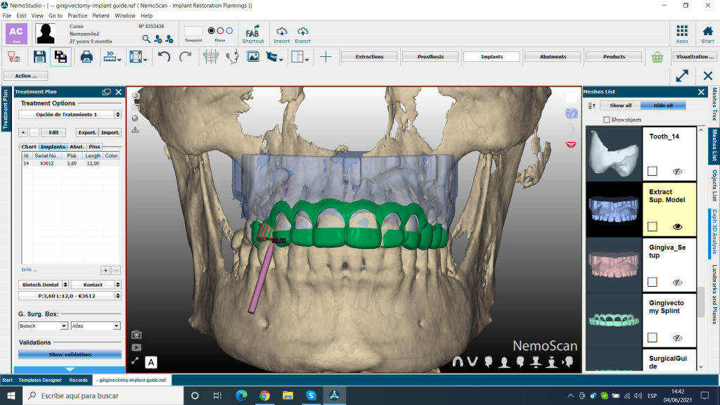 splint combinada de guia de gingivectomia y guia quirurgica de implantes (4)