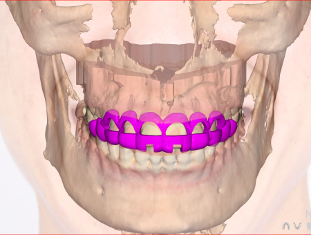 crown lenghtening 3